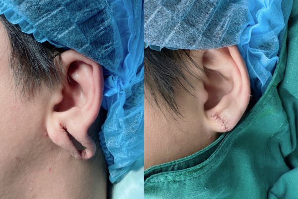 (Vá) Khâu lỗ tai có xỏ khuyên lại được không?