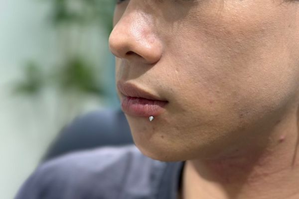 Hình ảnh lỗ xỏ khuyên đã lành hoàn toàn khỏe mạnh không sưng đỏ