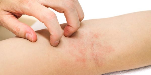 kiêng nước sau khi triệt lông để tránh kích ứng