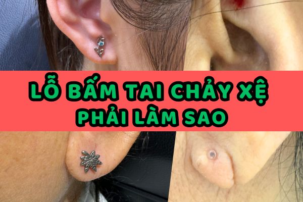 Lỗ bấm tai bị chảy xệ phải làm sao?