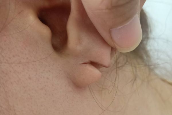 Lỗ bấm tai bị chảy xệ phải làm sao?