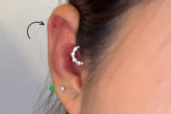 Lỗ xỏ bị viêm: Nguyên nhân ít ai ngờ & giải pháp từ Tinybox