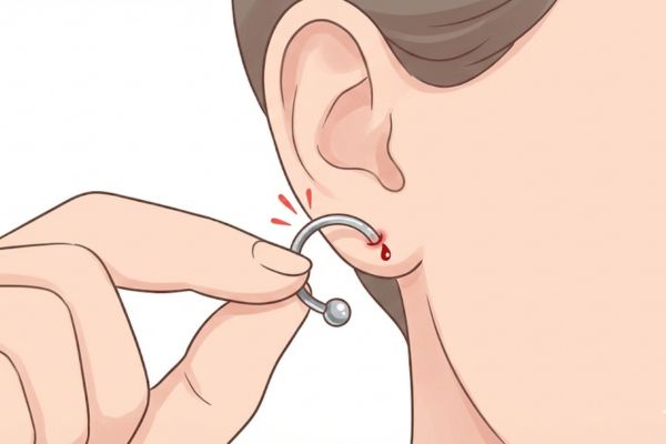 Lỗ xỏ biến dạng vì công thức "cộng dồn" tai hại