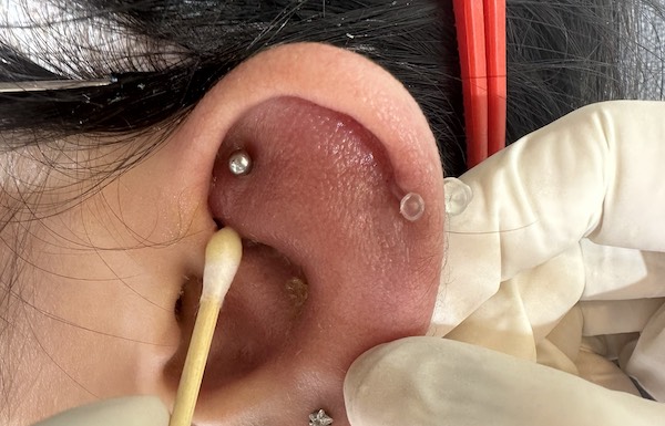Lỗ xỏ khuyên bị viêm sụn nên làm gì