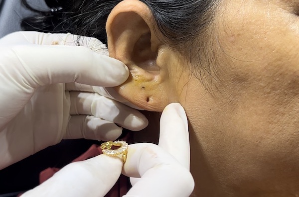 Lỗ xỏ khuyên sau 1 tháng tuổi nên làm gì?