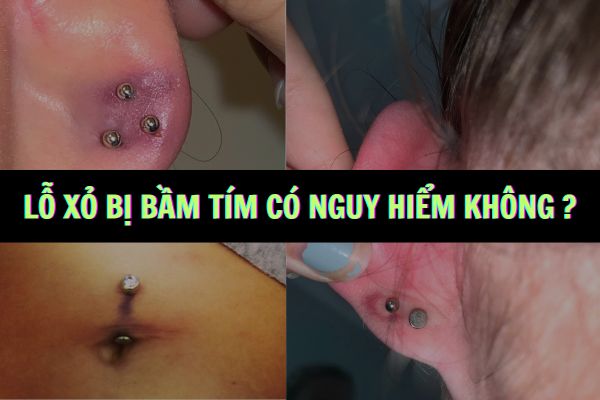 Lỗ xỏ khuyên tai bị bầm tím có sao không?