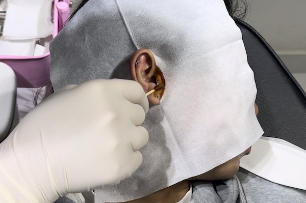 Mới xỏ khuyên ăn thịt vịt có bị sẹo lồi không?