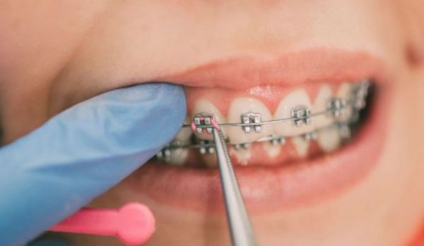 Niềng răng xỏ khuyên smiley được không?