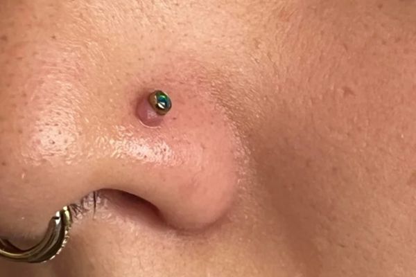 Phân biệt bump và sẹo lồi trong xỏ khuyên chuẩn nhất