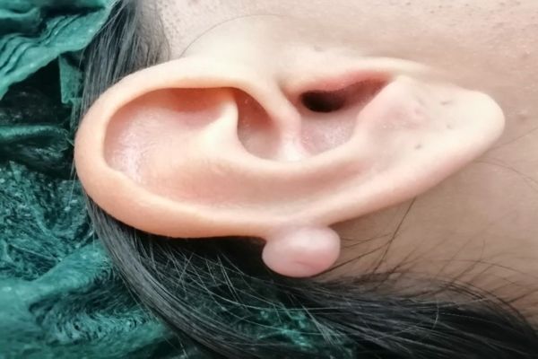 Phân biệt bump và sẹo lồi trong xỏ khuyên chuẩn nhất