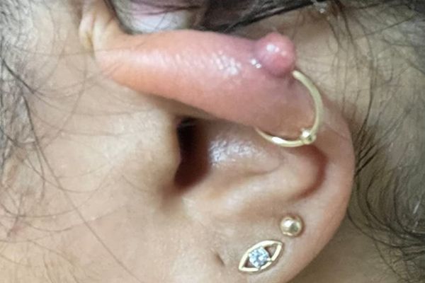 Phân biệt bump và sẹo lồi trong xỏ khuyên chuẩn nhất