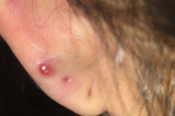 Phân biệt bump và sẹo lồi trong xỏ khuyên chuẩn nhất