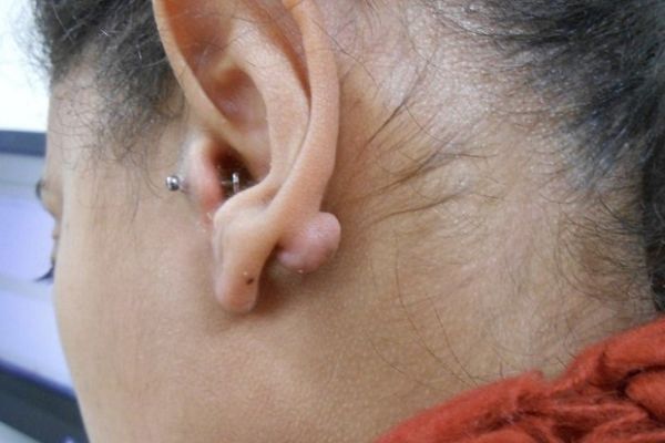 Phân biệt bump và sẹo lồi trong xỏ khuyên chuẩn nhất