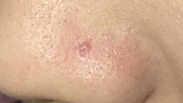 Cách phân biệt lỗ xỏ bị phồng và bị bump trong xỏ khuyên