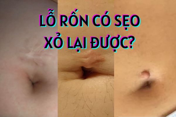 Rốn có sẹo xỏ lại được không