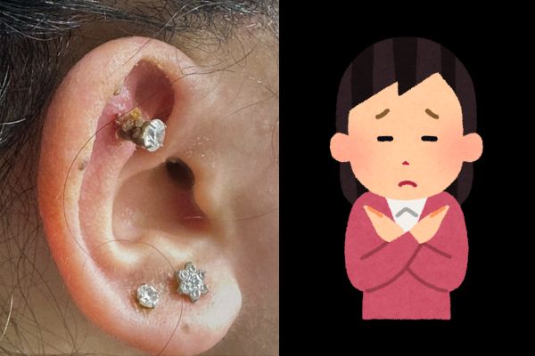 Tình trạng lỗ xỏ bị sưng dai dẳng hoài không khỏi thường do sai lầm trong cách chăm sóc (không vệ sinh lỗ xỏ)