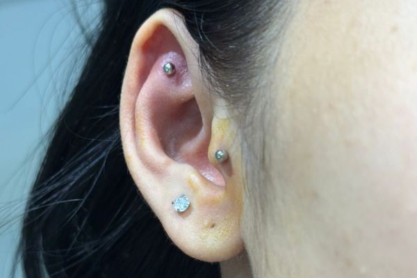 Hình ảnh lỗ xỏ bị sưng đỏ nhẹ trong tuần đầu - Đây thường là phản ứng viêm tự nhiên của cơ thể.