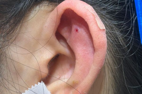 5 nguyên nhân phổ biến khiến lỗ xỏ bị sưng từ phản ứng tự nhiên đến các yếu tố dai dẳng.