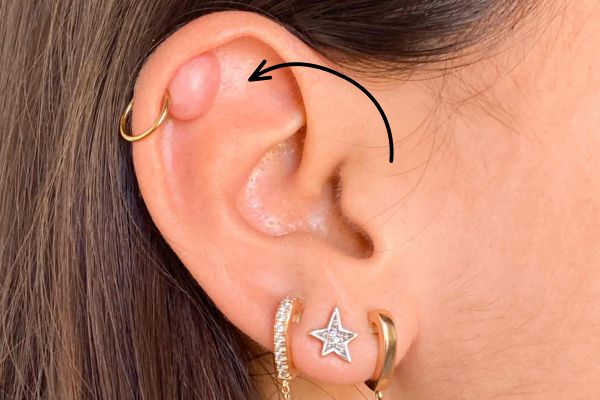 Tại sao lỗ xỏ chưa lành đeo khuyên tròn dễ bị sẹo lồi?