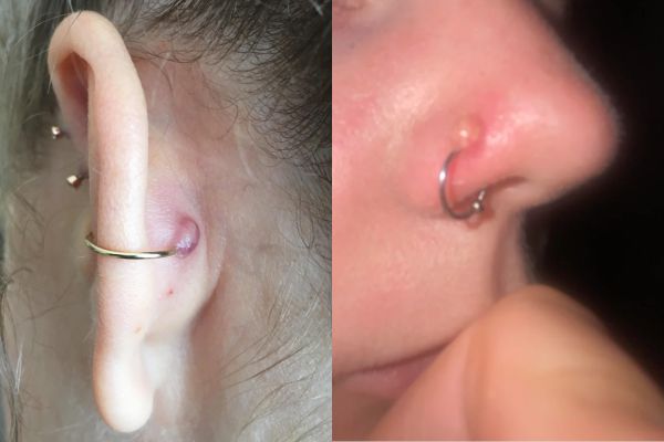 Tại sao lỗ xỏ chưa lành đeo khuyên tròn dễ bị sẹo lồi?
