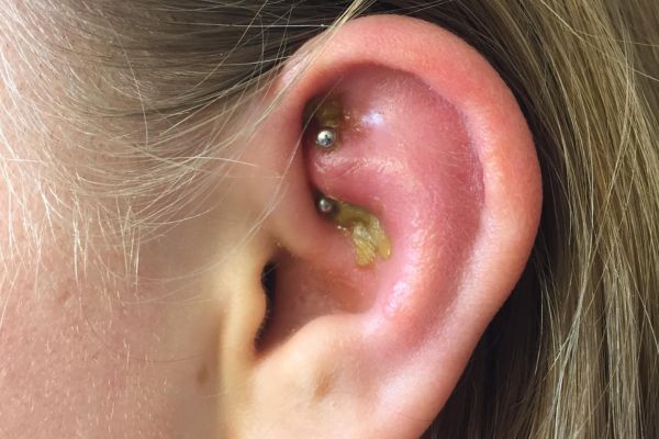 Tại sao xỏ khuyên dùng chất liệu tốt mà vẫn bị nhiễm trùng? 