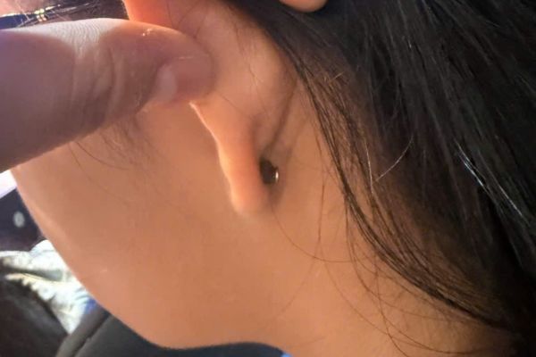 Tại sao xỏ khuyên kiêng ăn nhưng vẫn bị bump?