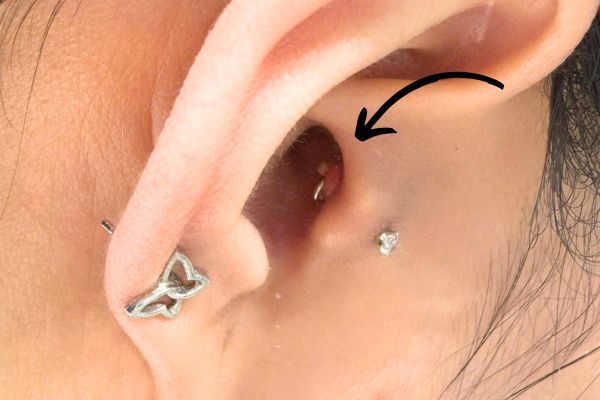 Tại sao xỏ khuyên kiêng ăn nhưng vẫn bị bump?