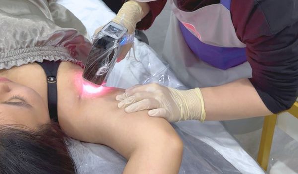 triệt lông diode laser tại TinyBox triệt tận gốc nang lông