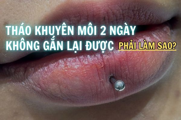 Tháo khuyên môi 2 ngày không gắn lại được phải làm sao?