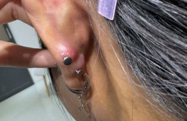 Thay khuyên sớm có sao không? Khi nào cần thay khuyên sớm?