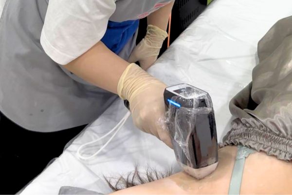 Triệt lông Diode Laser tại TinyBox