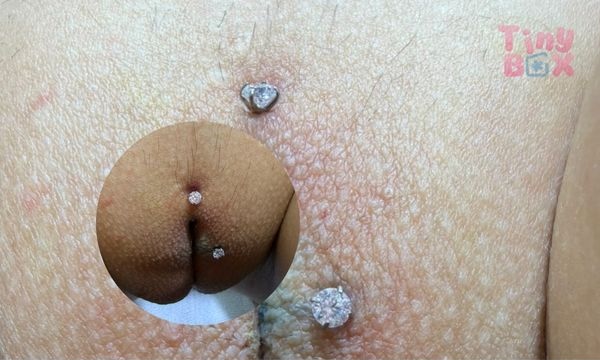 triệt lông làm đẹp cô bé 