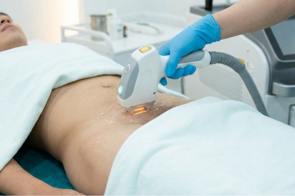 Triệt lông vùng kín nam có đau không? 