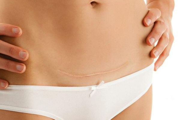 Triệt lông vùng kín sau sinh được không