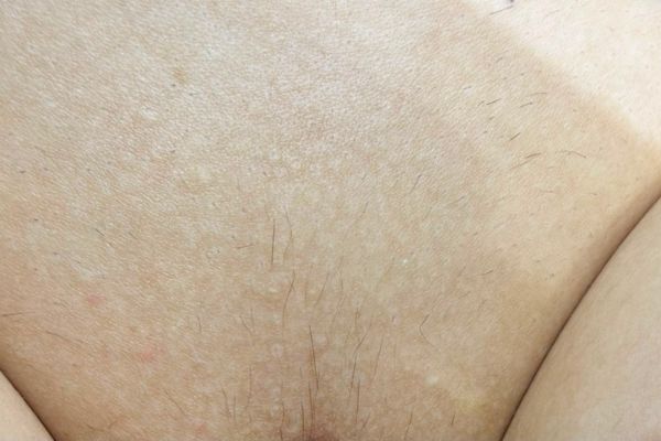 ưu điểm của công nghệ diode laser