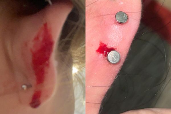 Vì sao lỗ xỏ khuyên tai bị chảy máu? 5 bước xử lí tại nhà an toàn!