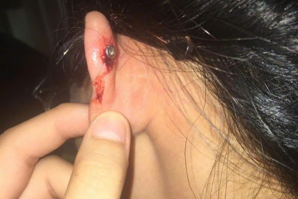 Vì sao lỗ xỏ khuyên tai bị chảy máu? 5 bước xử lí tại nhà an toàn!