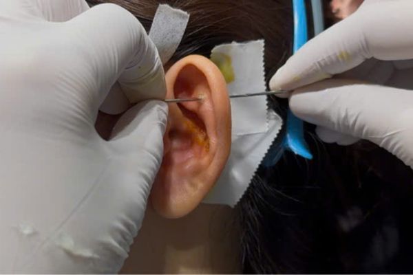 Xỏ Flat bao lâu lành?