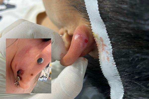 Xỏ khuyên ăn thịt bò bị gì không? Lỗ xỏ có bị sẹo lồi?