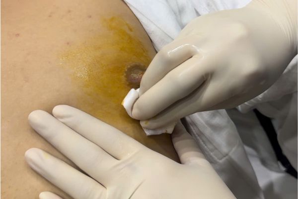 Xỏ khuyên đầu ti nam và 5 điều bạn cần biết