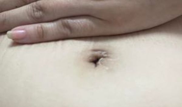 Xỏ khuyên rốn ảnh hưởng đến vết mổ nội soi trước đó không?