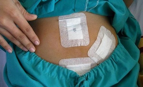 Xỏ khuyên rốn ảnh hưởng đến vết mổ nội soi trước đó không?