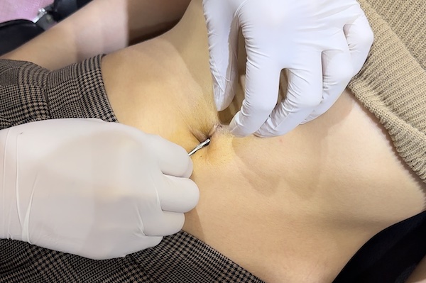 Xỏ khuyên rốn ảnh hưởng đến vết mổ nội soi trước đó không?