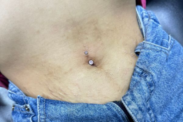 Xỏ khuyên rốn bị chảy máu phải làm sao?