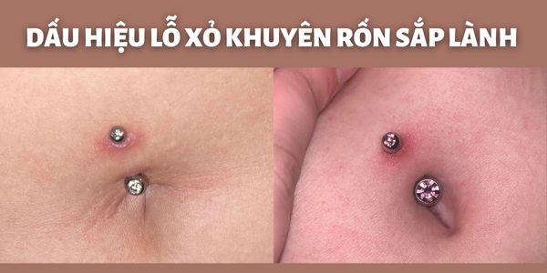 Cách chữa xỏ khuyên rốn bị lồi thịt hiệu quả và đơn giản tại nhà