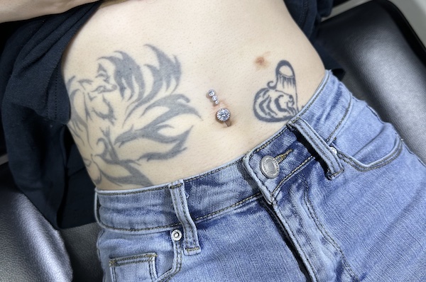 ảnh xỏ khuyên rốn có tiền sử sẹo lồi