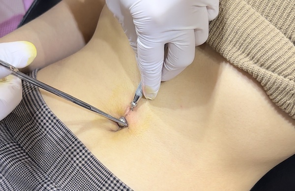 ảnh xỏ khuyên rốn có tiền sử sẹo lồi