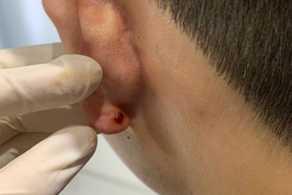 Xỏ lobe bị bump không?