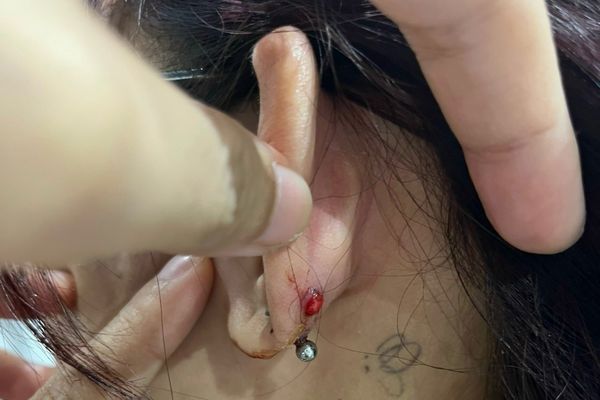 Xỏ lobe bị bump không?