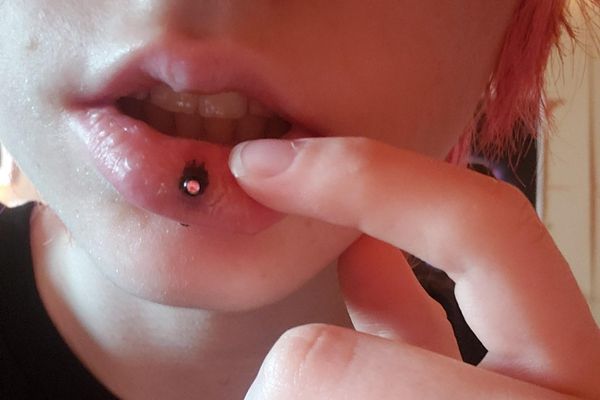 Xỏ môi bị chảy máu phải làm sao?